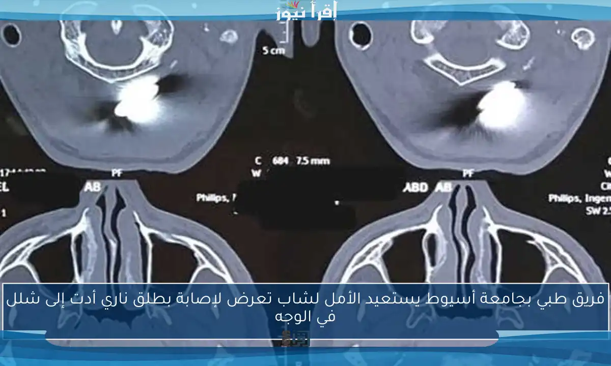 فريق طبي بجامعة أسيوط يستعيد الأمل لشاب تعرض لإصابة بطلق ناري أدت إلى شلل في الوجه